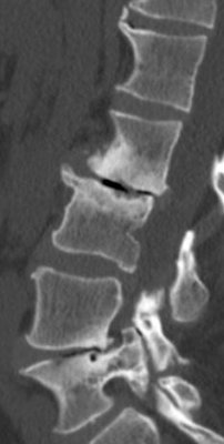 bone spur and disc degeneration L23.JPG