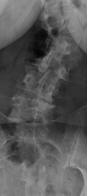 lumbar spine 1 scoliosis.JPG