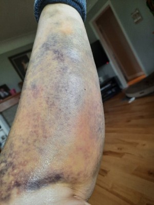 my bruise.jpg